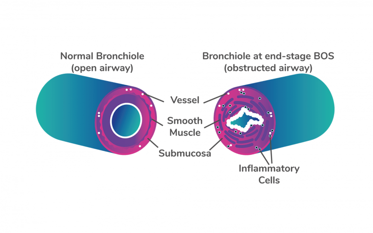 Bronchiole with open airway and with obstructed airway
