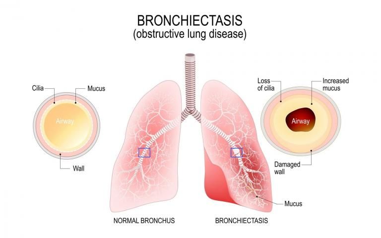 Bronchiectasis