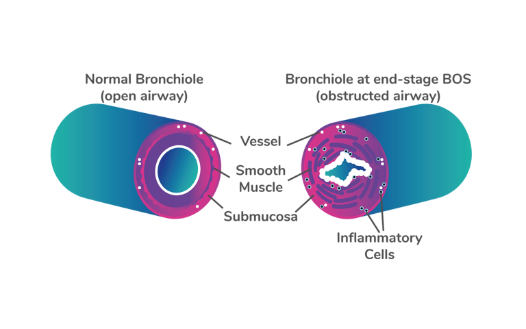 Bronchiole with open airway and with obstructed airway